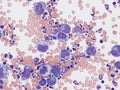 B-cell lymphoma in pleural fluid