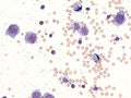 Pleural lymphoma, Cytology. Royalty Free Stock Photo