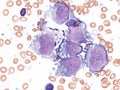 Pleural lymphoma, Cytology. Royalty Free Stock Photo