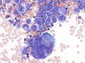 Pleural lymphoma, Cytology. Royalty Free Stock Photo