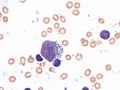 Pleural lymphoma, Cytology.