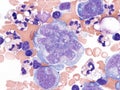 Pleural lymphoma, Cytology.