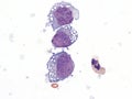 Pleural lymphoma, Cytology.