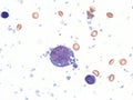 Pleural lymphoma, Cytology.