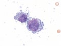 Pleural lymphoma, Cytology.