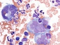 Pleural lymphoma, Cytology.