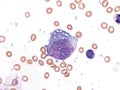 Pleural lymphoma, Cytology. Royalty Free Stock Photo