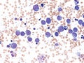Pleural lymphoma, Cytology. Royalty Free Stock Photo