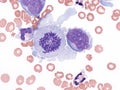 Pleural lymphoma, Cytology.