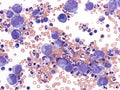 Pleural lymphoma, Cytology.