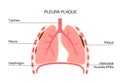 Pleural plaque poster