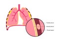 Pleural plaque poster