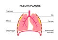 Pleural plaque poster