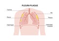 Pleural plaque poster