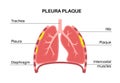 Pleural plaque poster