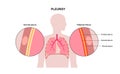 Pleurisy inflammation diseases