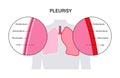 Pleurisy inflammation diseases