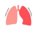 Pleurisy inflammation diseases