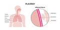 Pleurisy inflammation diseases