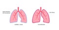 Pleurodesis medical procedure