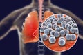 Pneumococcal pneumonia, medical concept Royalty Free Stock Photo