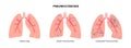 Pneumoconiosis lung disease