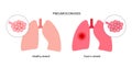 Pneumoconiosis lung disease