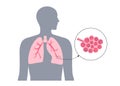 Pneumoconiosis lung disease