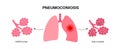 Pneumoconiosis lung disease