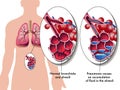 Pneumonia