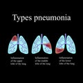 Pneumonia. The anatomical structure of the human lung. Type of pneumonia. Vector illustration on a black background Royalty Free Stock Photo