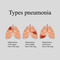 Pneumonia. The anatomical structure of the human lung. Type of pneumonia. Vector illustration on a gray background