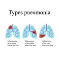 Pneumonia. The anatomical structure of the human lung. Type of pneumonia. Vector illustration on isolated background Royalty Free Stock Photo