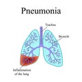 Pneumonia. The anatomical structure of the human