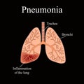 Pneumonia. The anatomical structure of the human lung. Vector illustration on a black background