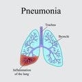 Pneumonia. The anatomical structure of the human lung. Vector illustration on a gray background