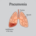 Pneumonia. The anatomical structure of the human lung. Vector illustration on a gray background