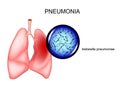 Pneumonia. causative agent - Klebsiella