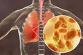 Pneumonia caused by Haemophilus influenzae bacteria, medical concept