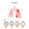 Pneumonia is caused by infection with viruses, bacteria, fungi and microorganism Royalty Free Stock Photo