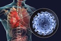 Pneumonia caused by a novel Wuhan coronavirus, medical concept