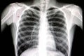 pneumonia chest film