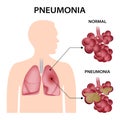 Pneumonia concept background, realistic style