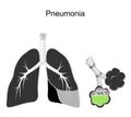 Pneumonia. Cross section of human lungs and alveolus with green fluid