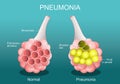 Pneumonia. Cross section of normal alveolus, and Alveoli are filled with fluids