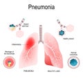 Pneumonia. Difference and Comparison of healthy lungs bronchioles and alveoli and pneumonia