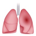 Pneumonia disease lungs icon, realistic style