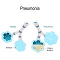 Pneumonia. Illustration shows normal and infected alveoli.