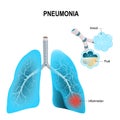 Pneumonia. human lungs, and inflamed alveoli Royalty Free Stock Photo