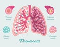 Pneumonia in human lungs. Inflammation lungs - including due to COVID-19. Respiratory diseases